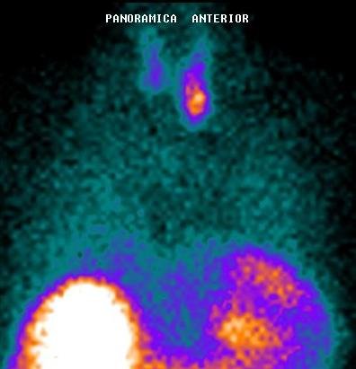 paratiroides 2 Estudio Positivo para Adenoma Paratiroideo Inferior Derecho